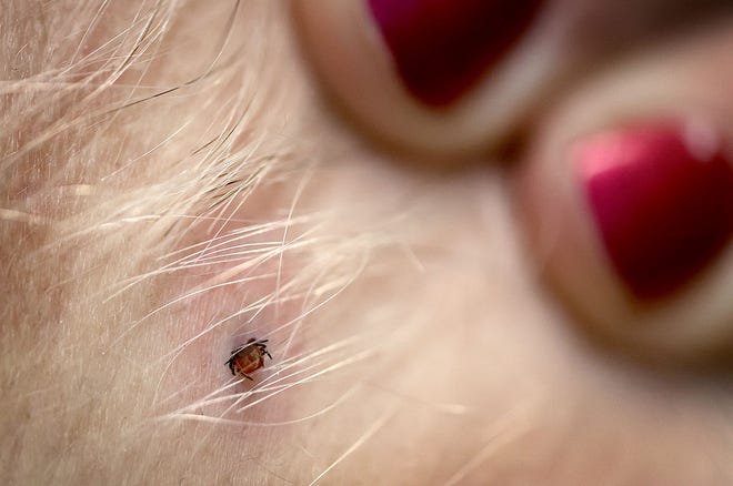 This deer tick was embedded in a Marshfield woman's neck. Left unchecked, deer ticks can transmit Lyme disease to humans. Researchers say protein in human sweat may protect against the disease.